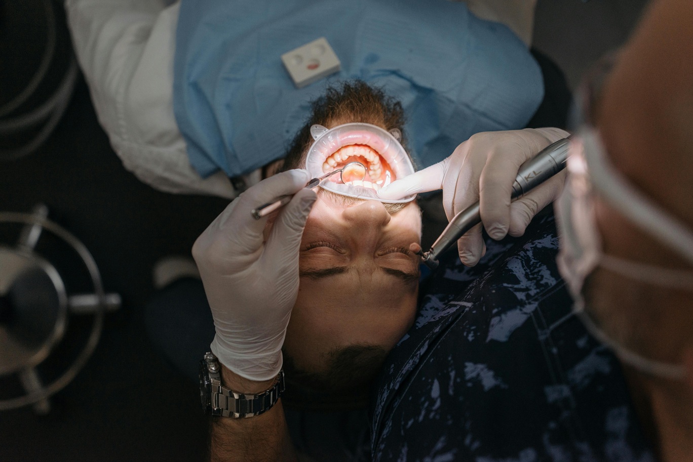 composite fillings 1